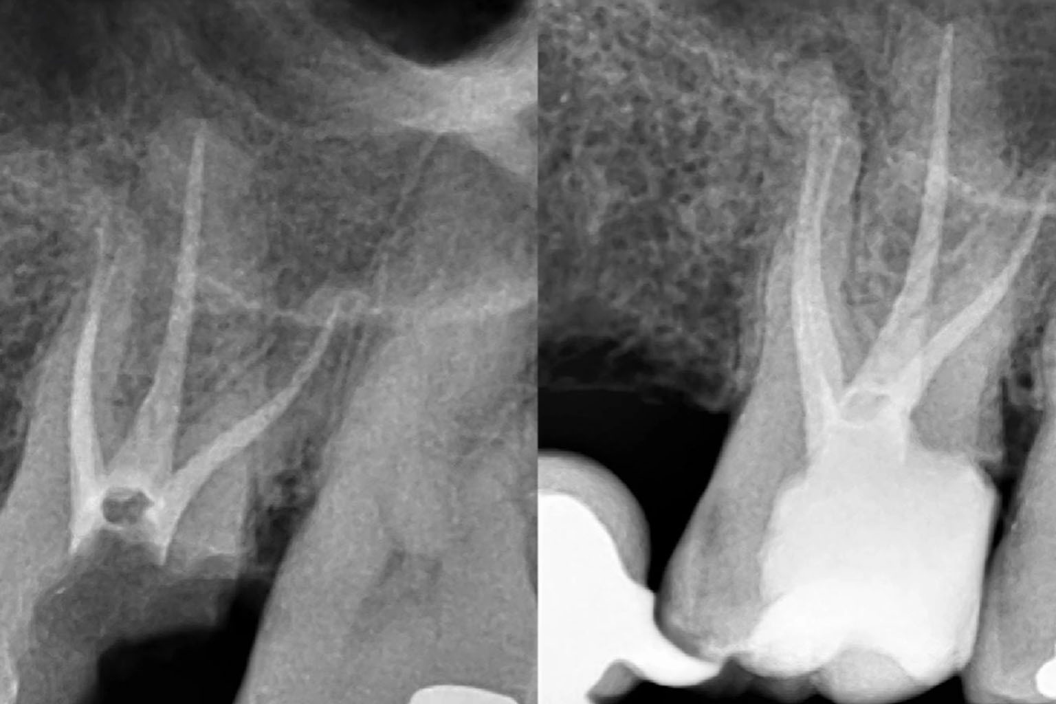 caso endodoncia